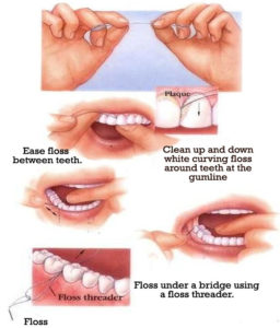 This photo gives step by step instructions on how to use dental floss properly