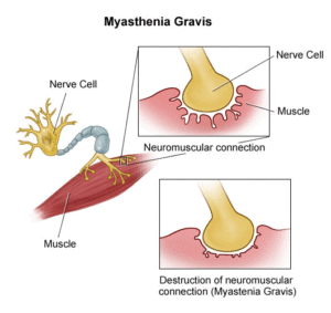 Myasthenia Gravis