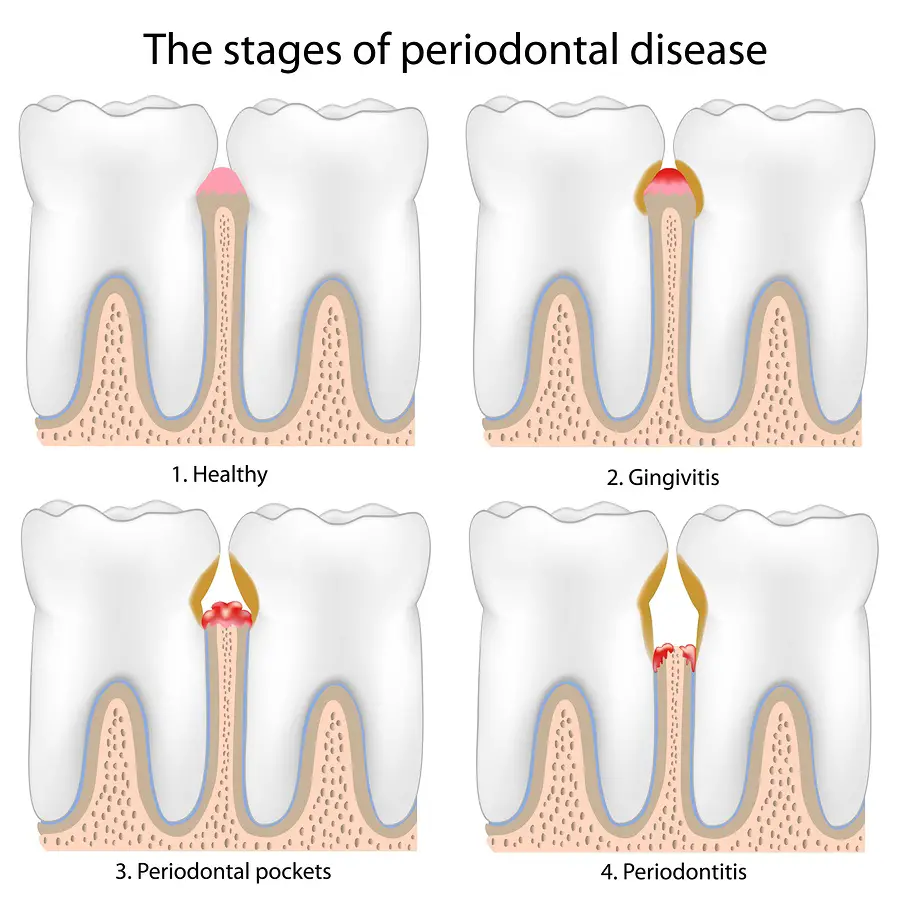 bigstock-periodontal-disease-175788231