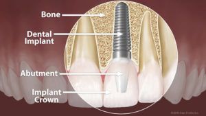 dental-implant-anatomy-large