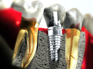 dental-implants