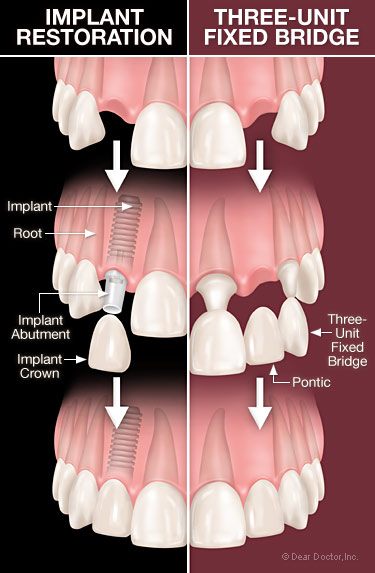 dental-implants-vs-bridgework