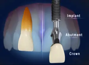 implant structure