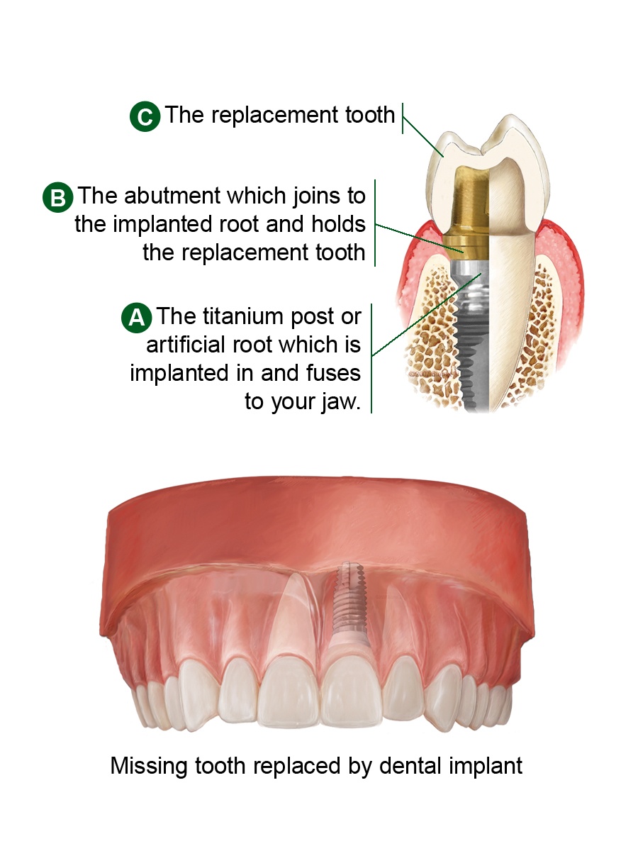 implants-diagram-large