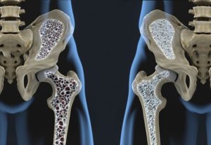 osteoporosis