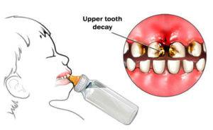 nursing-bottle-caries