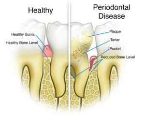 gum-disease