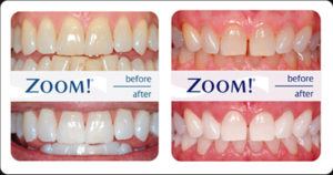 zoom-before-after-1