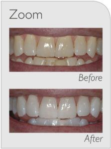 zoom teeth whitening before and after, amazon, youtube, groupon, coupon, los angeles, boston, what not to eat after