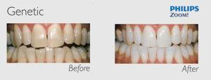 zoom-before-after-3, dc, special offer, specials, philips uk, ii, brisbane, london, calgary, san antonio, utah, images, faq