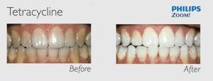 zoom-before-after-2, near me, special offers, reviews on, san francisco, teeth whitening zoom reviews, locations, charlotte nc, cincinnati, chicago, miami