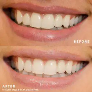 best teeth whitening gel