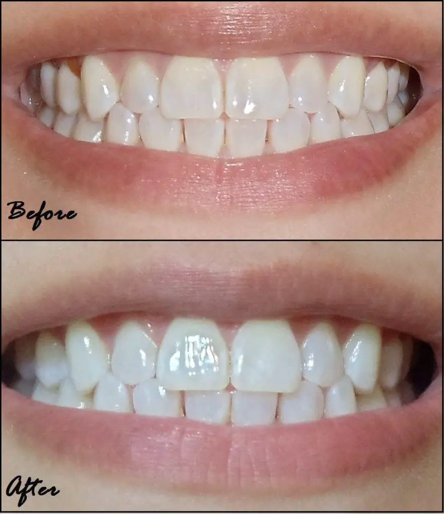 crest strips whitening mouthwash before whitestrips teeth noticeably using dentalsreview healthrow water hours