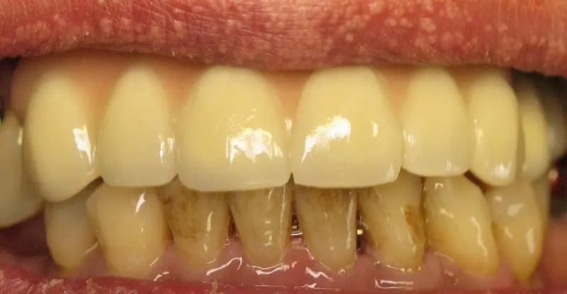 teeth stains bad very plaque fix smoking brown causes smoke whiten effective them having cos cavities why dentalsreview too sit
