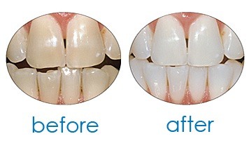 before and after using crest 3d white strips