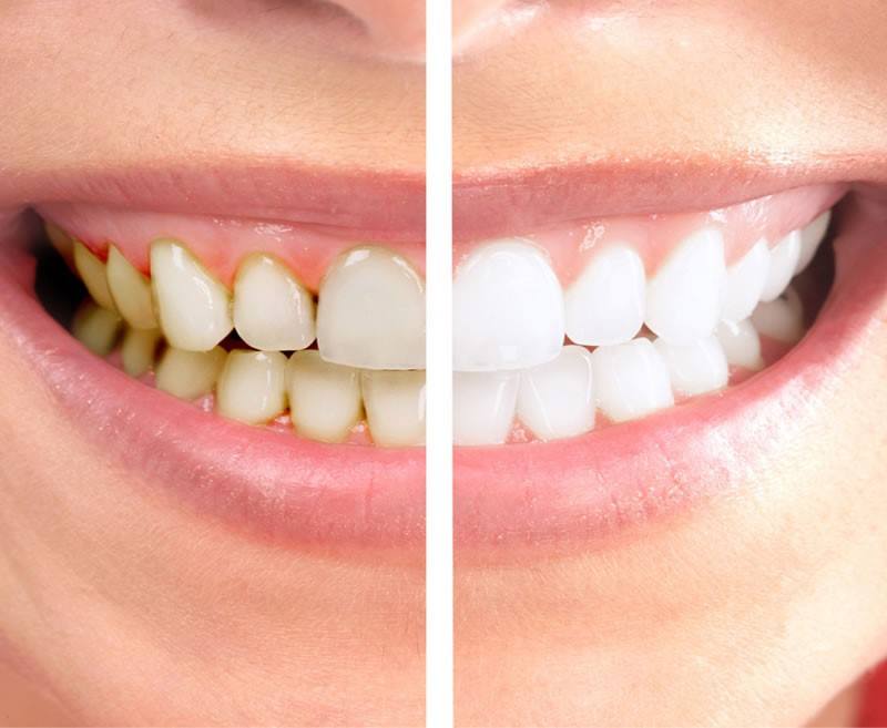 Remove Plaque and Keep the Teeth Healthy