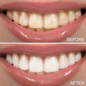 before and after using lovely premium whitestrips