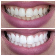 supersmile teeth whitening reviews