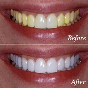 crest whitening strips yellow teeth