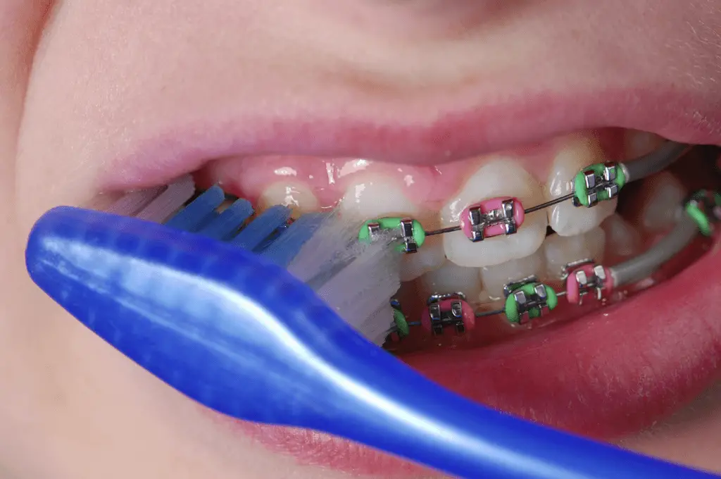5 Top Toothbrushes For Braces Review 2021 Best Orthodontic Choices