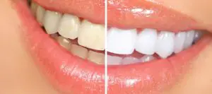 how long does zoom teeth whitening last