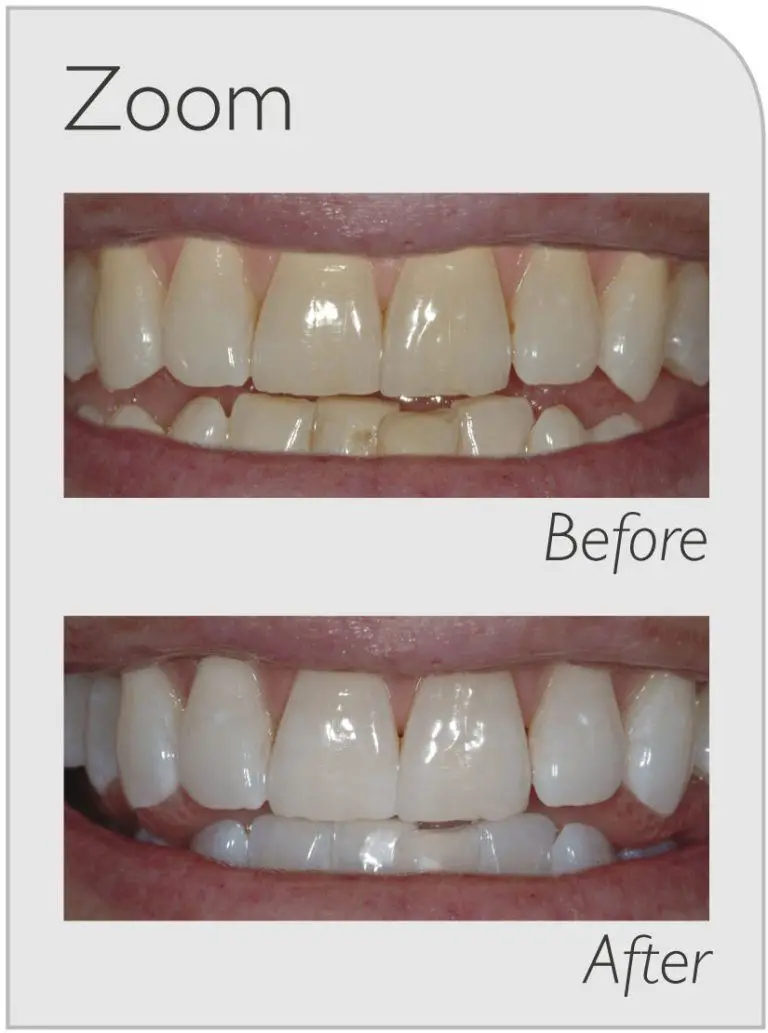 is zoom whitening worth it