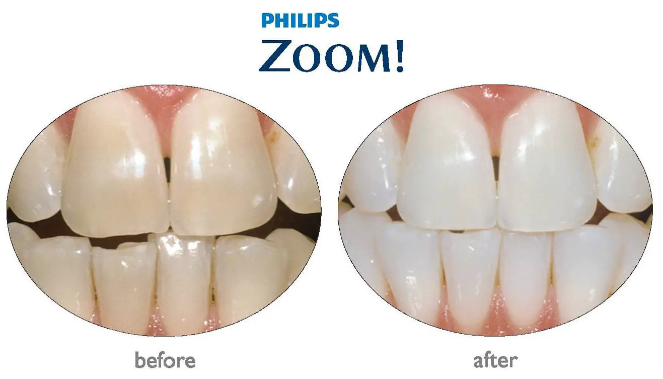 zoom whitening process