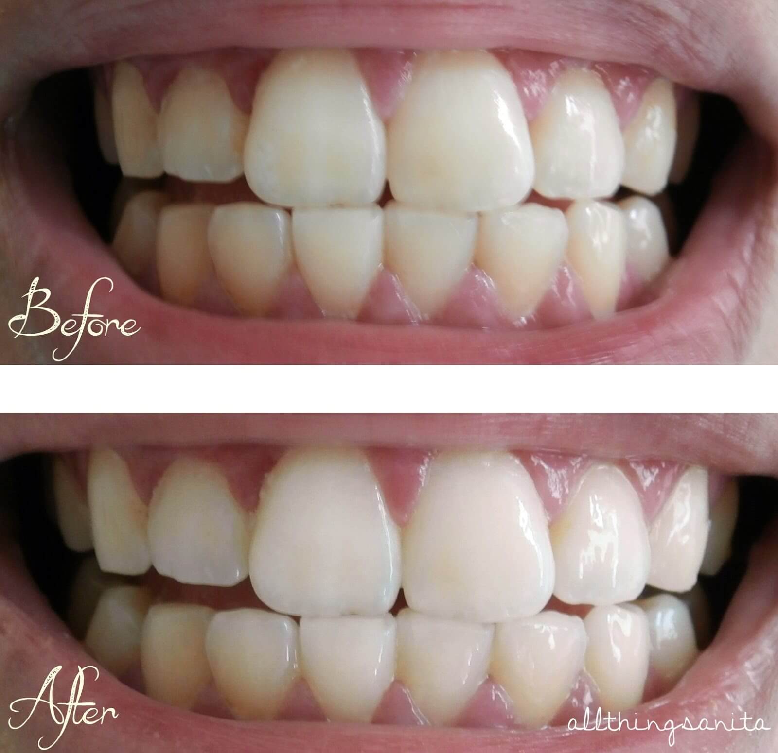 Does luster teeth whitening really work