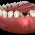 Why Do Teeth Fall Out? Common Causes and Prevention Tips - DentalsReview